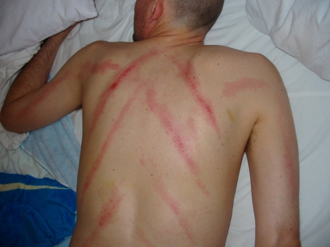 New Onset of Linear Purpura on the Back: Coining Therapy-Associated Ecchymoses - PMC